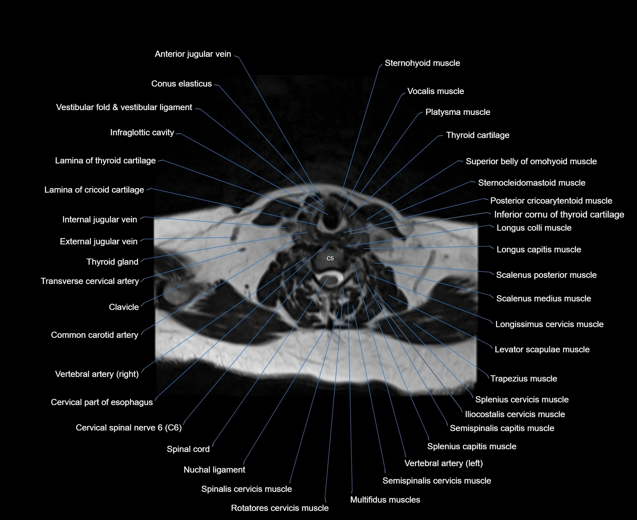 MRI Neck 3D labelled cross section anatomy axial 3t image-00001-00064.webp